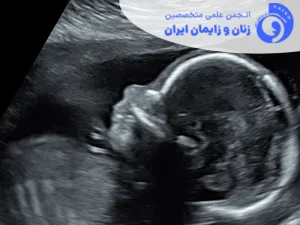 ضرورت استفاده از سونوگرافی برای تعیین پوزیشن سر جنین