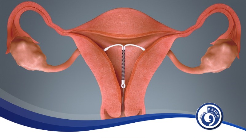 IUD