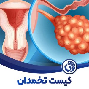 کیست تخمدان
