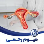 میوم رحمی