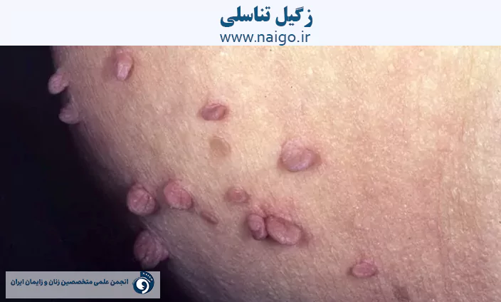 زگیل تناسلی