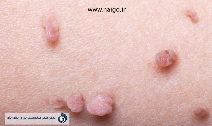 تاثیر زگیل تناسلی بر بارداری