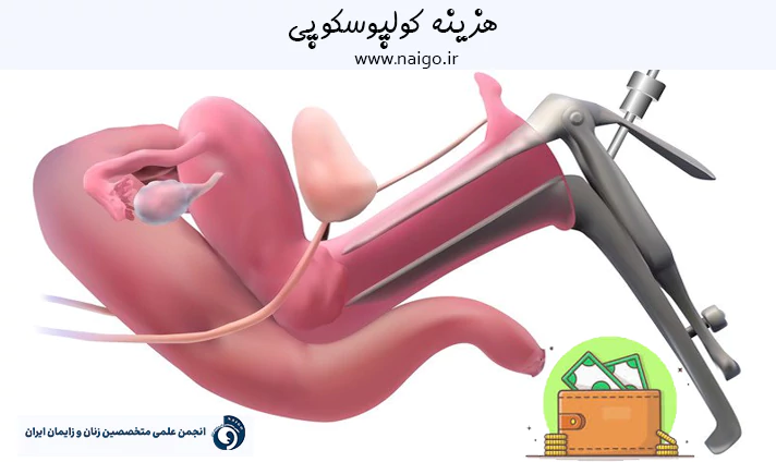 هزینه کولپوسکوپی