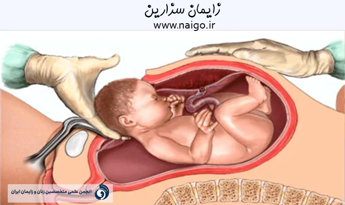 زایمان سزارین
